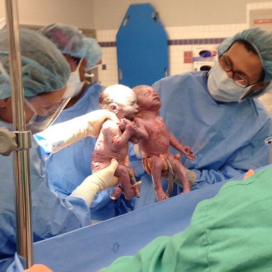 Эти моно-моно-близнецы родились в руках, два года спустя они все еще неразделимы
