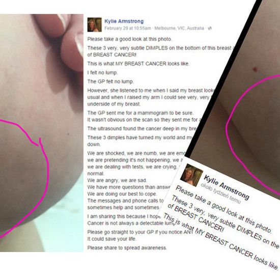 Это то, что мой рак выглядит: австралиец показывает фотографию ямочек в сундуке - сильное предупреждение для всех нас