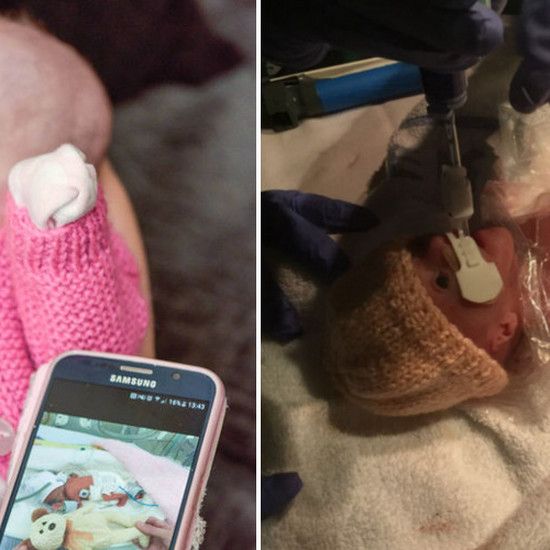 Кошелек с фольгой спас ей жизнь - маленькая Эмили родилась с тонкой кожей