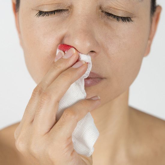 Кровотечение из носа: каковы причины, как их остановить, недостаток витаминов? Как вылечить