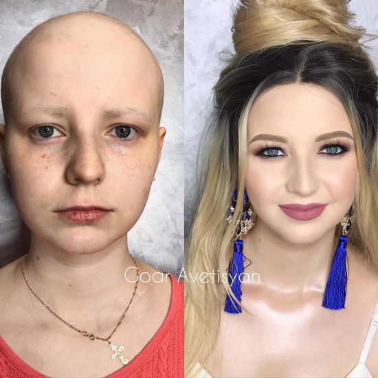Они борются с раком, шрамами и акне - макияж полностью меняет его