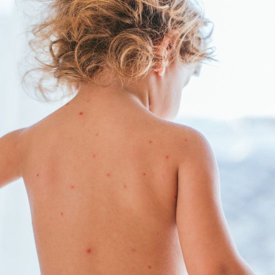 Моллюскин - кожная болезнь распространена у дошкольников