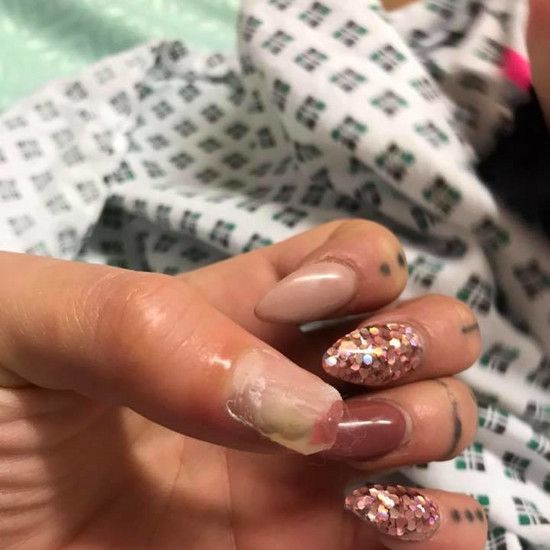 Она чуть не потеряла большой палец в результате инфекции после наложения искусственных ногтей