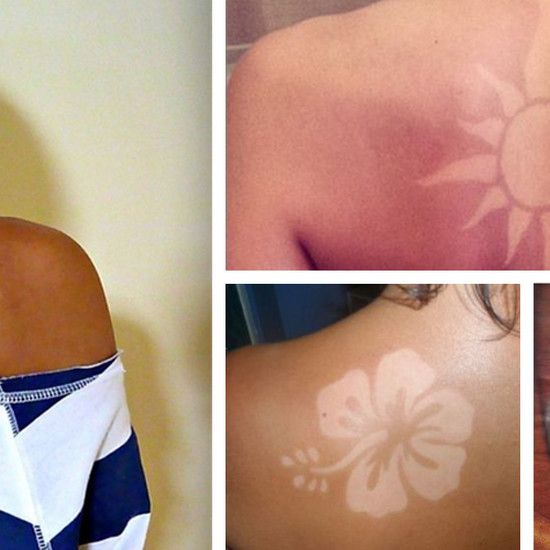 #sunburnart: татуировки на коже, сожженной солнцем. Опасная, глупая летняя тенденция - это интернет