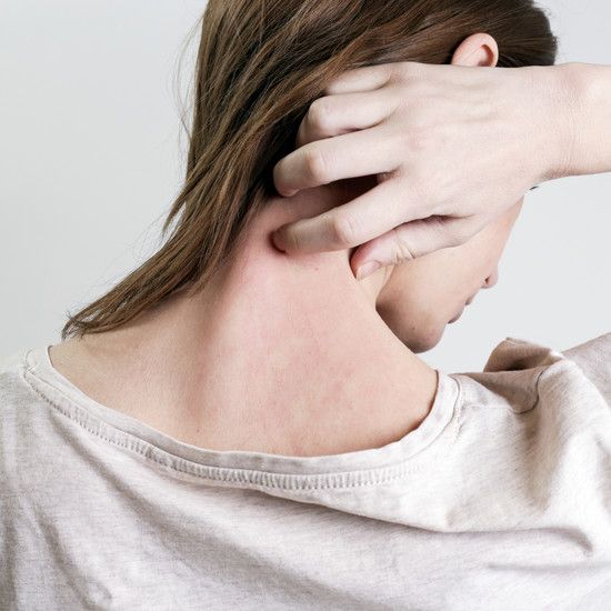 Lupus erythematosus - что такое болезнь, которая поражает главным образом женщин детородного возраста?